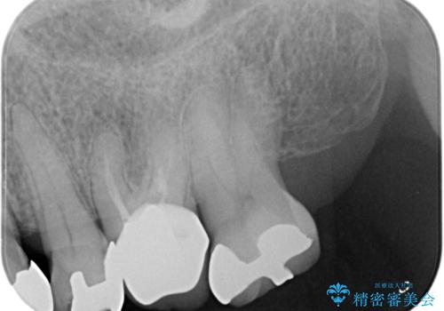 70代女性 段差のある被せ物のやり替え の治療前