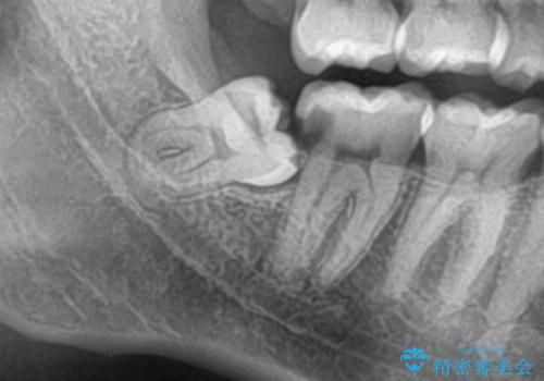 斜めに生えてきている親知らずを抜きたいの治療前