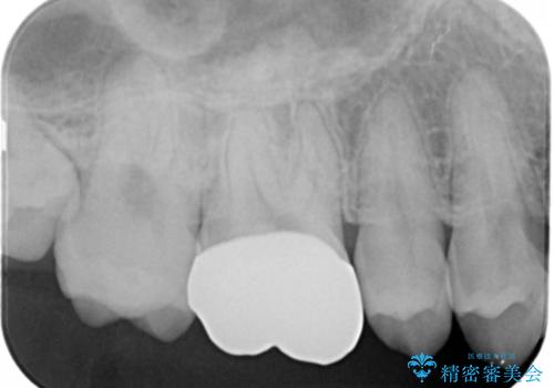 銀歯を白くしたい フルジルコニアクラウンとセラミックインレーの治療後
