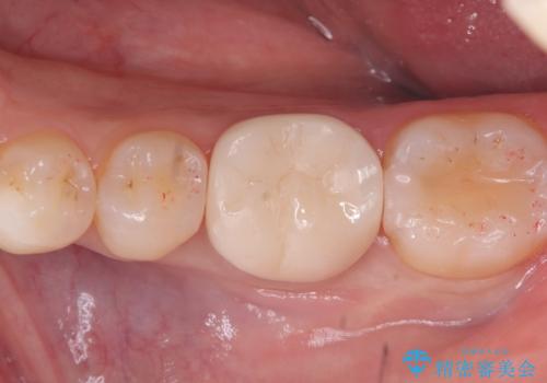 【セラミッククラウン】歯がポロポロ欠けたの治療後