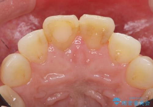 [ セラミック治療 ]  前歯の変色をきれいにしたいの治療前