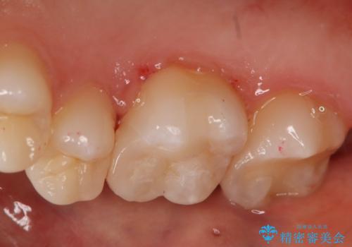 奥歯の保険の詰め物を自費のものに変えたいの治療後