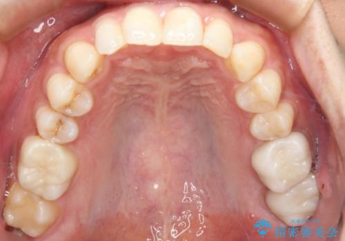 銀歯を白くしたい フルジルコニアクラウンとセラミックインレーの治療後