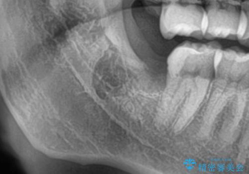 斜めに生えてきている親知らずを抜きたいの治療後