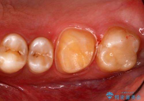銀歯を白くしたい フルジルコニアクラウンとセラミックインレーの治療中