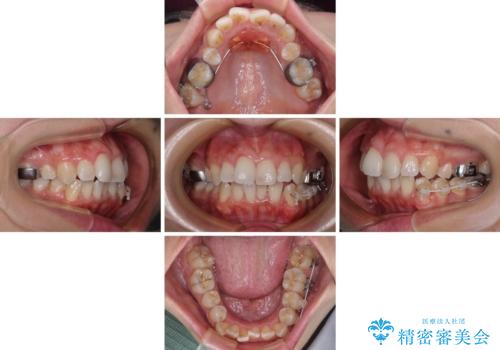 前歯のデコボコを改善　インビザラインの矯正治療の治療中
