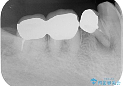 70代女性 状態の悪い歯を抜歯して、奥歯をブリッジにの治療前