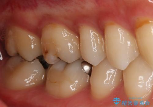 銀歯を白くしたい フルジルコニアクラウンとセラミックインレーの治療前
