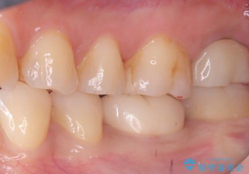 【セラミッククラウン】歯がポロポロ欠けたの治療後