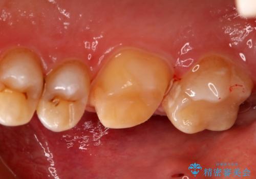 銀歯を白くしたい フルジルコニアクラウンとセラミックインレーの治療中