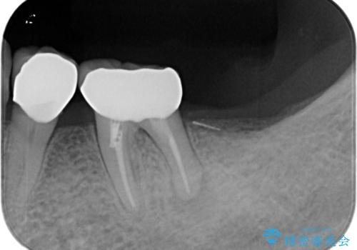 70代女性 段差のある被せ物のやり替え の治療後