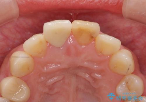 [ セラミック治療 ]  前歯の変色をきれいにしたいの治療後