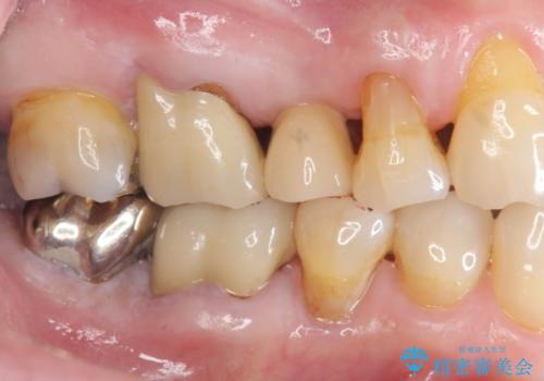 失った奥歯のインプラント治療の治療後