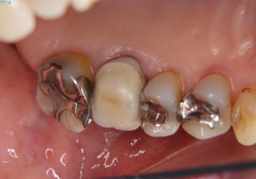 70代女性 段差のある被せ物のやり替え の治療前