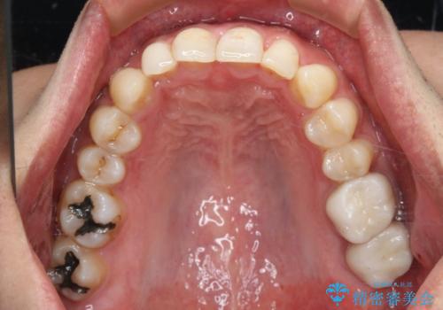 銀歯を白くしたい フルジルコニアクラウンとセラミックインレーの治療前