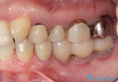 破折歯のインプラント治療、奥歯の根管・セラミック治療の症例 治療前