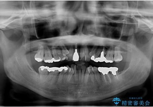 50代女性 八重歯を矯正治療 歯並びの中等度のがたつきの治療前