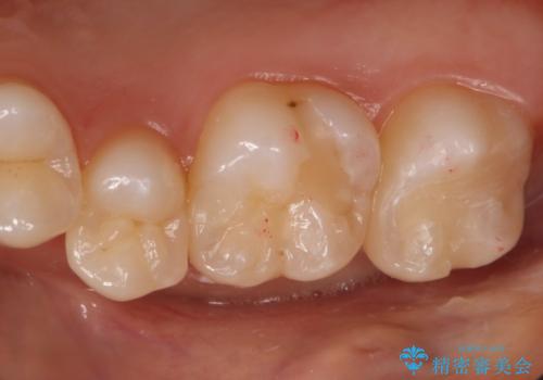 奥歯の保険の詰め物を自費のものに変えたいの治療前