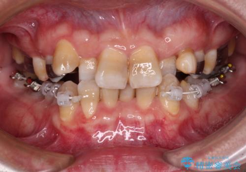 全体的なデコボコが気になる。拡大装置を併用したワイヤー矯正の治療中