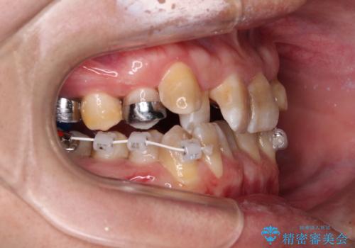 全体的なデコボコが気になる。拡大装置を併用したワイヤー矯正の治療中