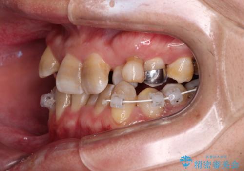 全体的なデコボコが気になる。拡大装置を併用したワイヤー矯正の治療中