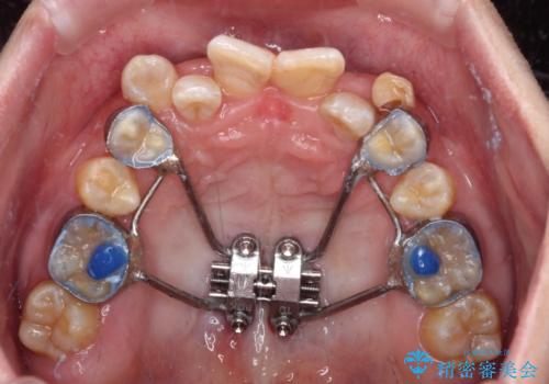 全体的なデコボコが気になる。拡大装置を併用したワイヤー矯正の治療中