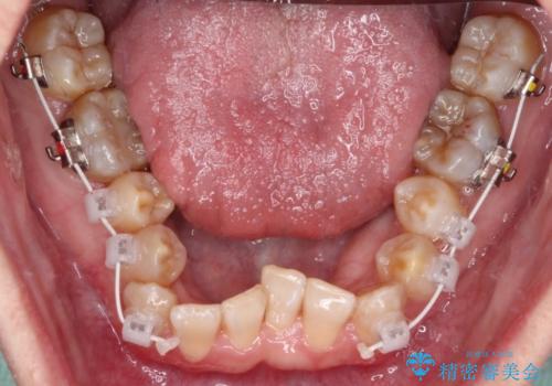 全体的なデコボコが気になる。拡大装置を併用したワイヤー矯正の治療中
