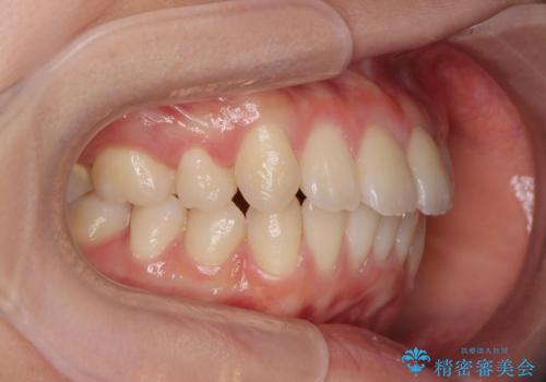 突き出た前歯の改善!マウスピースで再矯正の治療後