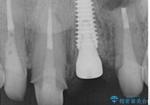 前歯4本のセラミック治療|抜歯即時インプラント+歯根端切除術で機能と美しさを回復の治療中
