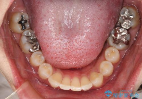 銀歯を白くしたい フルジルコニアクラウンとセラミックインレーの治療前