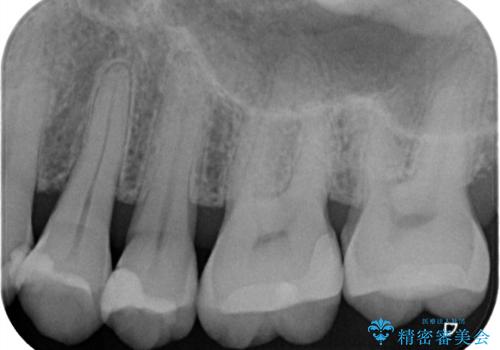 レントゲンで虫歯を発見 セラミックインレーの治療後