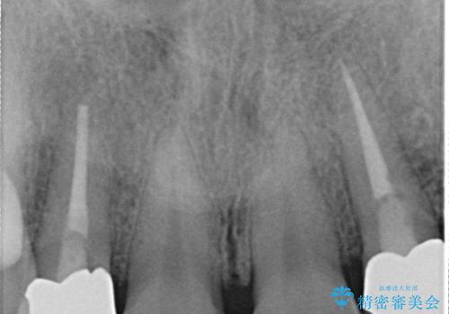 前歯のセラミッククラウン 詰め物が取れたの治療前