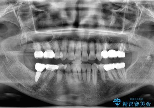 食いしばりが強い 歯周病全顎治療の治療後