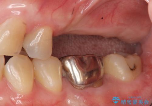 奥歯でしっかり噛める、インプラント治療の治療前