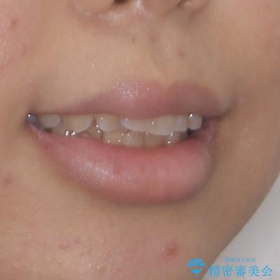 八重歯と上顎前突 ワイヤー装置での抜歯矯正の治療前(顔貌)