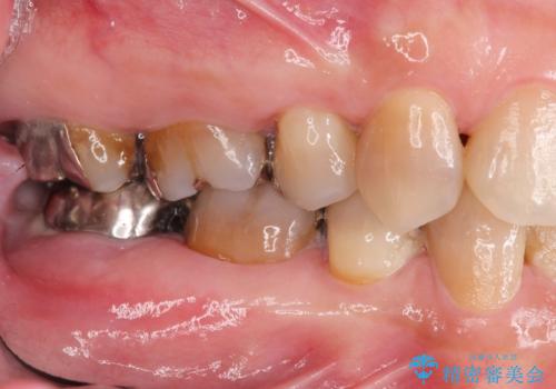 食いしばりが強い 歯周病全顎治療の治療前