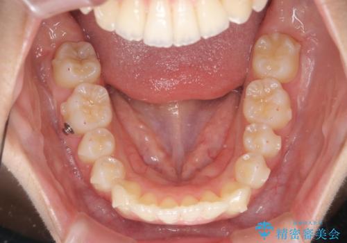 突き出た前歯の改善!マウスピースで再矯正の治療中