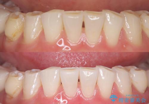 歯のホワイトニング