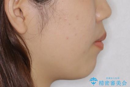 インビザラインが使えなかった:ワイヤーで仕上げ治療の治療前(顔貌)