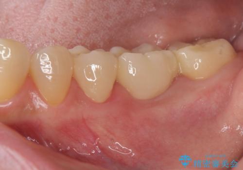 抜歯後の補綴 セラミックブリッジ治療
