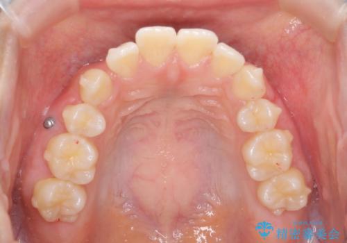 突き出た前歯の改善!マウスピースで再矯正の治療中
