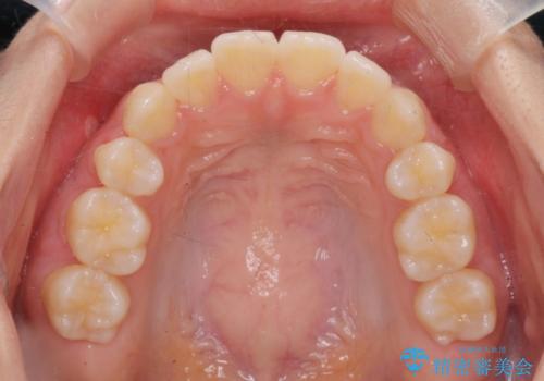 突き出た前歯の改善!マウスピースで再矯正の治療後
