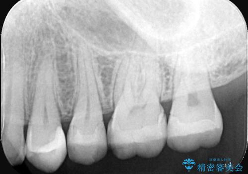 【セラミックインレー】詰め物が欠けたの治療前