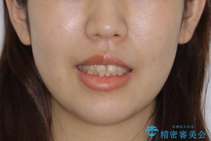 インビザラインが使えなかった:ワイヤーで仕上げ治療の治療前(顔貌)