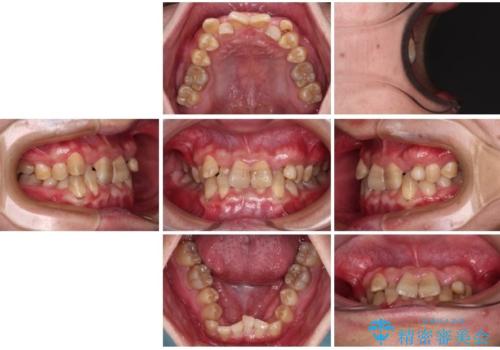 全体的なデコボコが気になる。拡大装置を併用したワイヤー矯正の治療前