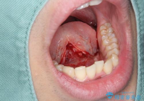 滑舌の改善 舌小帯の形成術の治療中