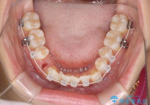 【審美装置】八重歯気になるの治療中