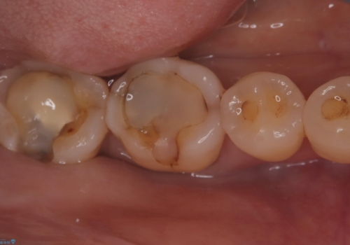 【セラミックインレー】プラスチックの劣化が気になるの治療中