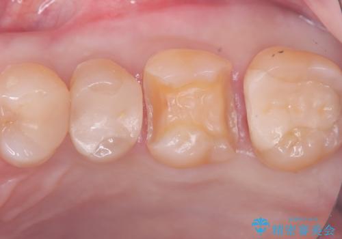 【セラミックインレー】詰め物が欠けたの治療中