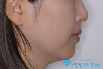 最小限の来院回数で歯並びを改善:インビザライン治療の治療後(顔貌)